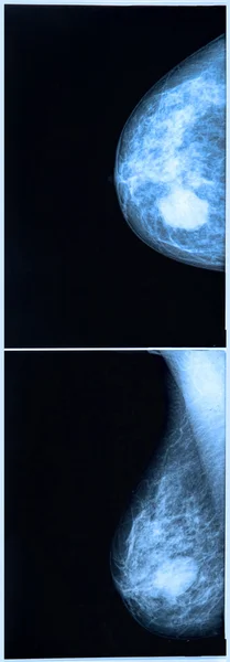 mamografi meme tarama X-ray