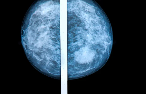 Mamografía gammagrafía de mama Radiografía Imagen De Stock