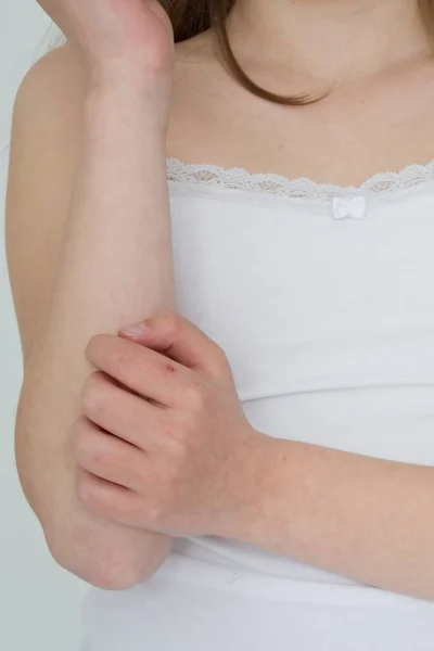 Kız dirseğini tırmalıyor, bu da kaşındırıyor çünkü atopik egzaması var. Kıştan sonra kurumuş deri, pullu deri, sedef, deri iltihabı, egzama ve alerji. Her yerim kaşınıyor.