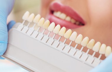 Avrupalı güzel bir kadın sağlıklı diş beyazlatıcı ile gülümsüyor. Diş bakımı konsepti. Farklı tonlarda implantlar.