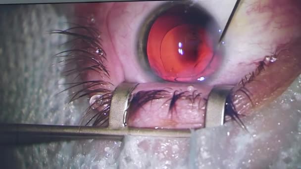 Close-upweergave van het oog op het laserscherm tijdens een gezichtscorrectie. 3D projectie van het oog op het scherm tijdens de operatie in de operatiekamer. — Stockvideo