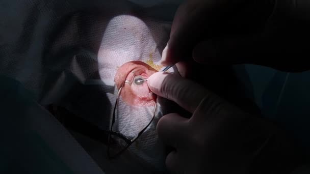 한 의사가 병원의 수술실에서 안 과 눈 수술을 받기 전에 진통제를 주사한다. — 비디오