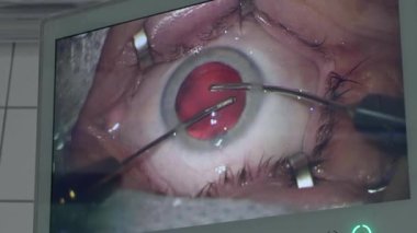 Ameliyat odasındaki cerrahi ekipman monitöründen göz ameliyatının yakın görüntüsü.