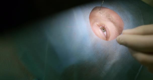 Egy közeli kép a beteg szeméről az asztalon fekszik a műtőben. Lézeres látásjavítás. Szemműtét orvosi rendelőben. — Stock videók