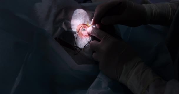 Chirurgia oka, chirurg operujący oko z bliska na sali operacyjnej w klinice medycznej. Procedury chirurgiczne w celu poprawy widzenia. — Wideo stockowe