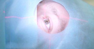 Lazer görüş düzeltmesi, göz ameliyatı için hazırlık. Steril pelerin altında hastaya yakın çekim ameliyathanede ameliyat masasında