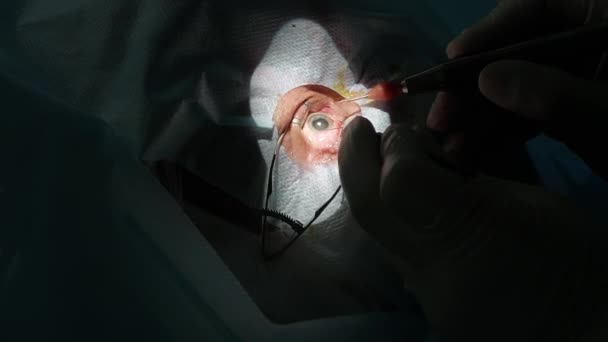 Gros plan sur la chirurgie oculaire en clinique d'ophtalmologie médicale. Chirurgiens mains fermer pendant la chirurgie oculaire — Video