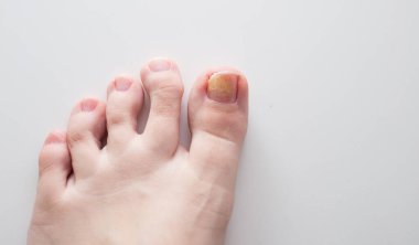 Tırnağındaki mantar. Ayak parmağında mantar hastalığı var. İlaç, tedavi