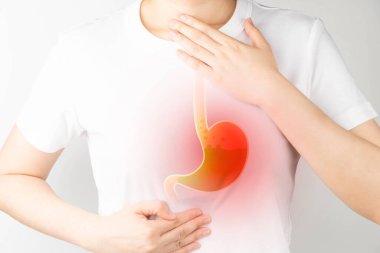 Gastroözofagus reflü hastalığı (GERD) veya asit reflü semptomları. Mide ekşimesi, karın ağrısı, bulantı ve şişkinlik çeken bir kadın. Gastrointestinal sistem hastalığı ve sindirim sorunları.