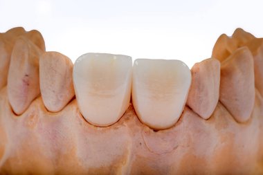 Metalsiz seramik diş kaplaması. Dişçi zirkon seramik taçlar model çene üzerinde.