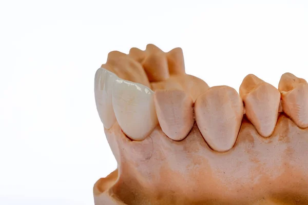 Coroas Dentárias Cerâmica Livre Metal Dental Zircão Coroas Cerâmica Mandíbula — Fotografia de Stock