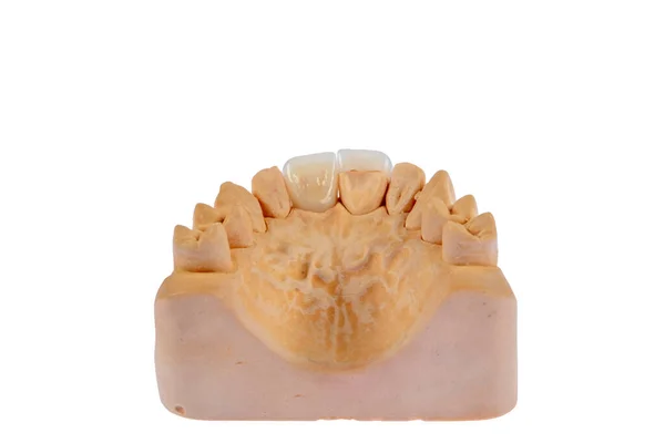 Coroas Dentárias Cerâmica Livre Metal Dental Zircão Coroas Cerâmica Mandíbula — Fotografia de Stock