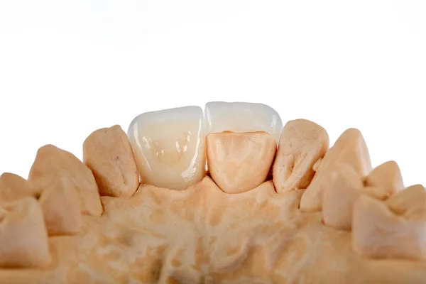 Coroas Dentárias Cerâmica Livre Metal Dental Zircão Coroas Cerâmica Mandíbula — Fotografia de Stock