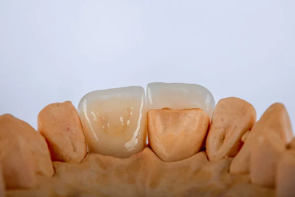 Metal free ceramic dental crowns. Dental zircon ceramic crowns on model jaw.