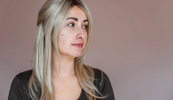 Vida Com Acne Problema Pele Propensa Erupções Cutâneas Acne Cicatrizes — Fotografia de Stock