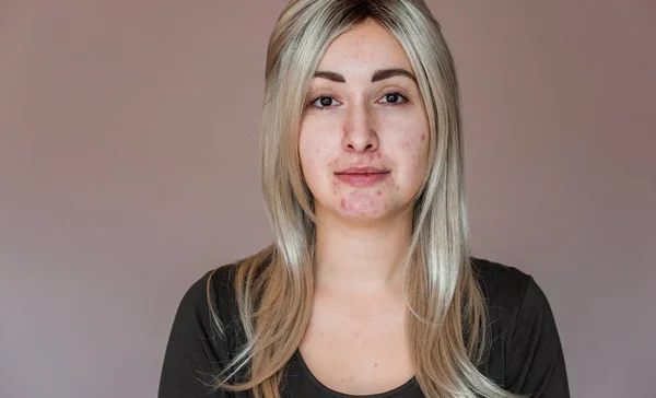 Sivilceli bir hayat, sivilcelere, kızarıklıklara, yaralara, sağlıklı cilt konseptine, dermatolojiye ve kozmetolojiye eğilimli sorunlu cilt.