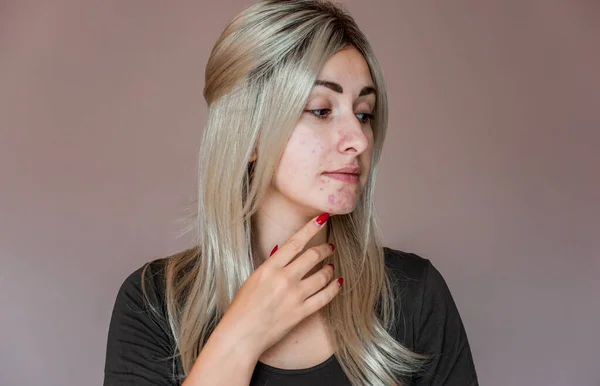 にきびとの生活 問題の皮膚は 発疹やにきびになりやすい 健康的な肌の概念 皮膚科と美容 — ストック写真