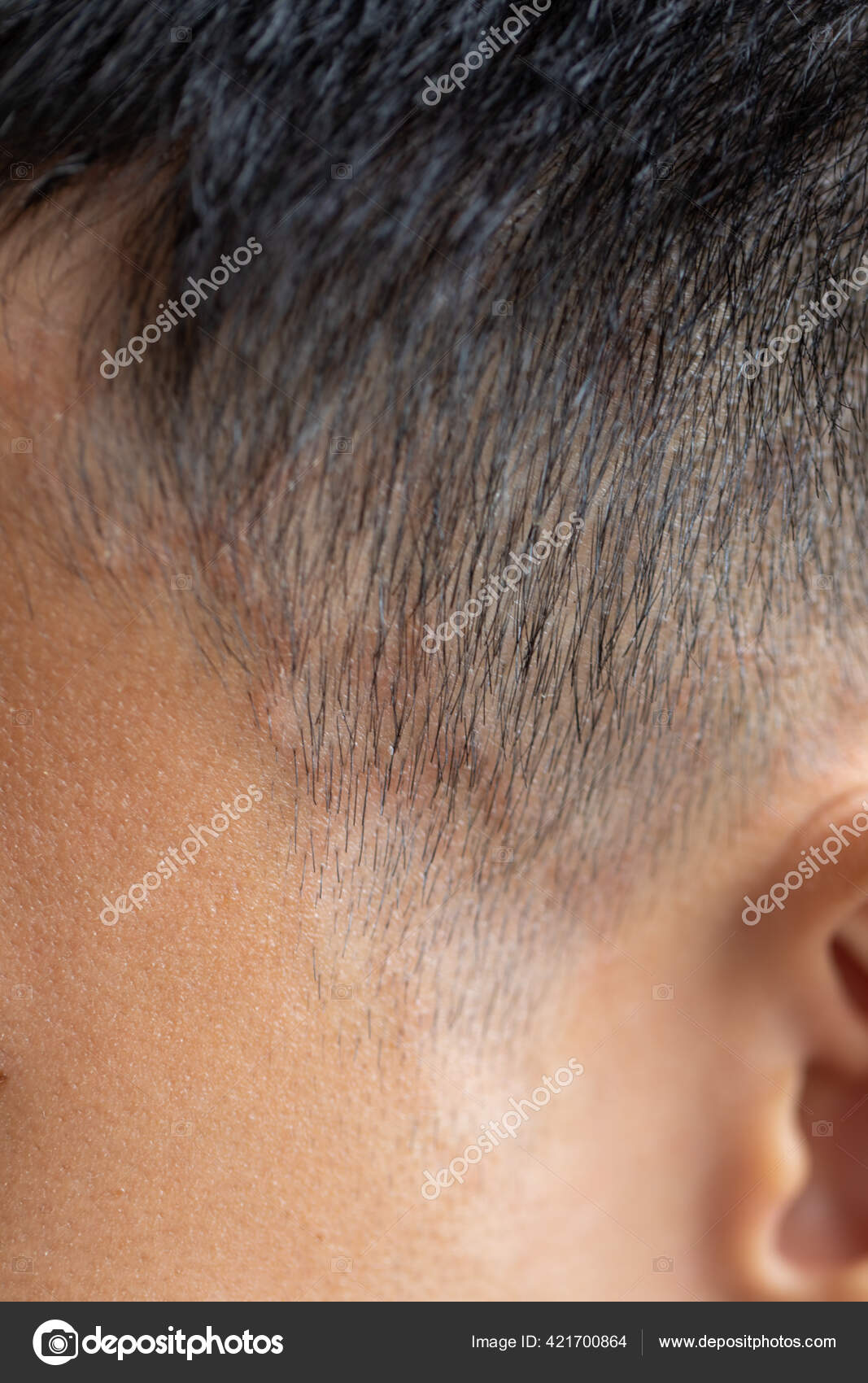 Tinea Circinata Ringworm Head Stock Photo by © 421700864 Tinea Circinata Ringworm Head Stock Photo by © 421700864