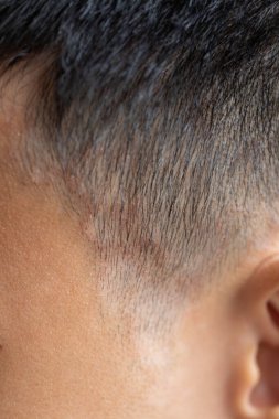 Tinea circinata ya da başında mantar..