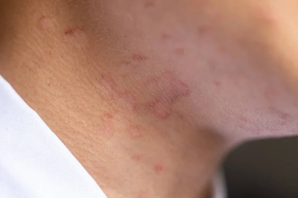 Tinea circinata ya da başında mantar..