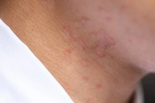 Tinea Circinata Ringworm Head — Stock Photo, Image