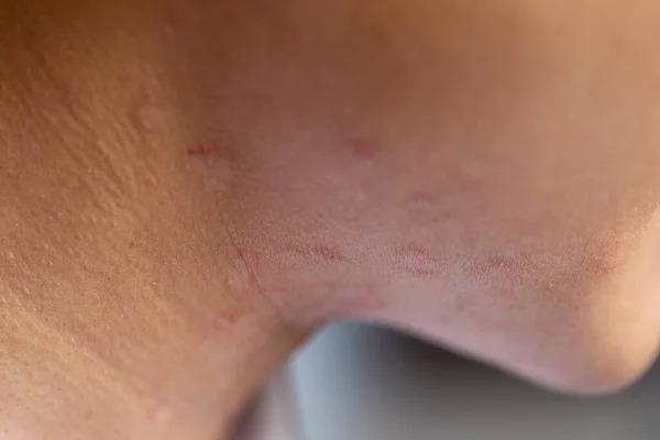 Tinea Circinata Vagy Sömör Fejen — Stock Fotó