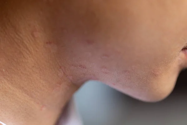 Tinea Circinata Vagy Sömör Fejen — Stock Fotó