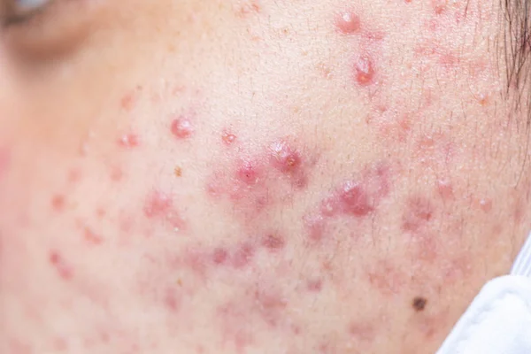 Klinikteki sivilcelerin sebep olduğu doku bozulmaları..