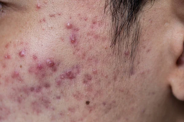 Antecedentes Lesões Pele Causadas Pela Acne Rosto Clínica — Fotografia de Stock