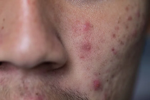 Antecedentes Lesões Pele Causadas Pela Acne Rosto Clínica — Fotografia de Stock