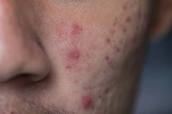 Antecedentes Lesões Pele Causadas Pela Acne Rosto Clínica — Fotografia de Stock