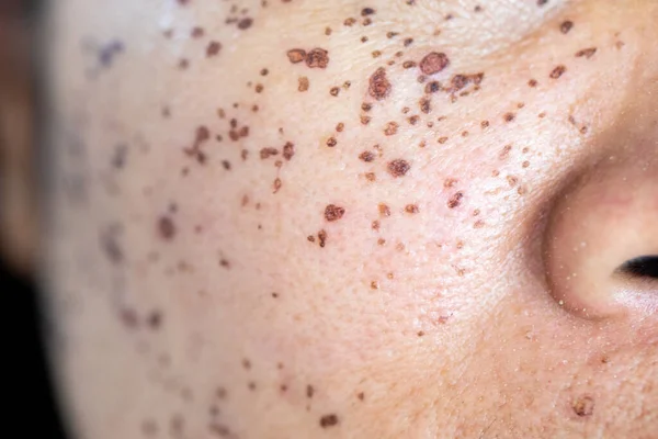 临床上痤疮引起的皮肤病变的背景 — 图库照片