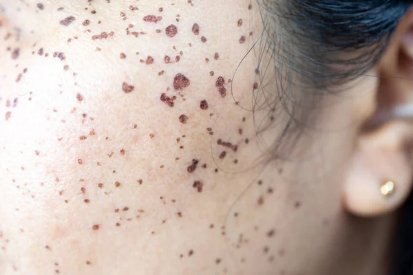 Antecedentes Lesões Pele Causadas Pela Acne Rosto Clínica — Fotografia de Stock