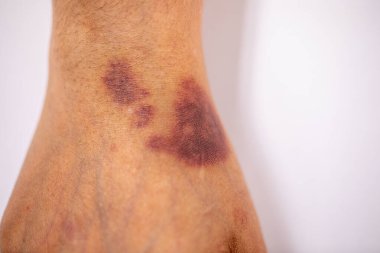Kolundaki yaranın fiziksel görünümü Haemophilia 'dan kaynaklanır (Haemophiliais genetik bir bozukluktur.)