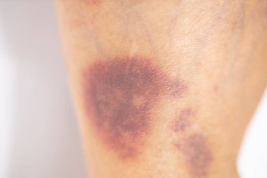 Kolundaki yaranın fiziksel görünümü Haemophilia 'dan kaynaklanır (Haemophiliais genetik bir bozukluktur.)