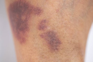 Kolundaki yaranın fiziksel görünümü Haemophilia 'dan kaynaklanır (Haemophiliais genetik bir bozukluktur.)