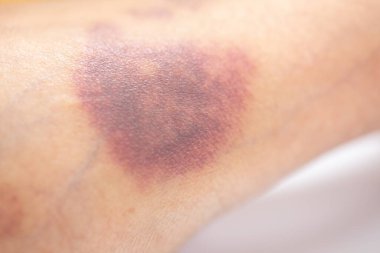 Kolundaki yaranın fiziksel görünümü Haemophilia 'dan kaynaklanır (Haemophiliais genetik bir bozukluktur.)