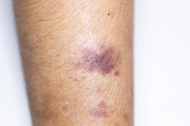 Kolundaki yaranın fiziksel görünümü Haemophilia 'dan kaynaklanır (Haemophiliais genetik bir bozukluktur.)