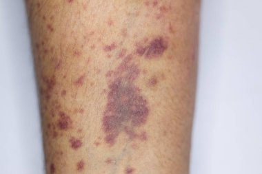 Kolundaki yaranın fiziksel görünümü Haemophilia 'dan kaynaklanır (Haemophiliais genetik bir bozukluktur.)
