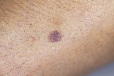 Kolundaki yaranın fiziksel görünümü Haemophilia 'dan kaynaklanır (Haemophiliais genetik bir bozukluktur.)