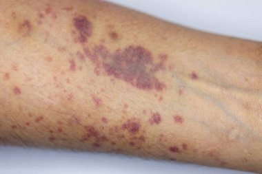 Kolundaki yaranın fiziksel görünümü Haemophilia 'dan kaynaklanır (Haemophiliais genetik bir bozukluktur.)