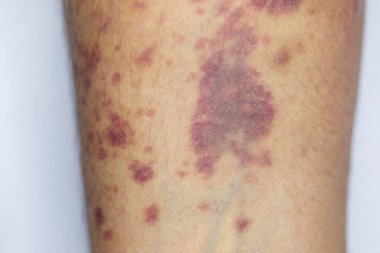 Kolundaki yaranın fiziksel görünümü Haemophilia 'dan kaynaklanır (Haemophiliais genetik bir bozukluktur.)