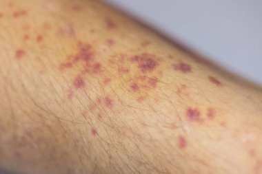 Kolundaki yaranın fiziksel görünümü Haemophilia 'dan kaynaklanır (Haemophiliais genetik bir bozukluktur.)