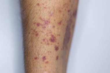 Kolundaki yaranın fiziksel görünümü Haemophilia 'dan kaynaklanır (Haemophiliais genetik bir bozukluktur.)