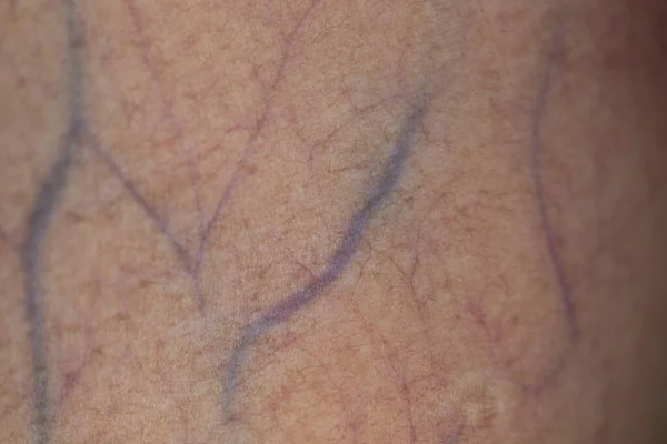 Внешний Вид Руки Раной Вызван Гемофилией Гемофилия Наследственное Генетическое Заболевание — стоковое фото
