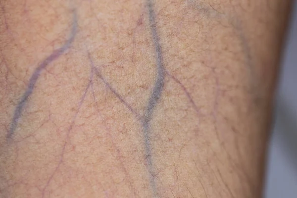 Внешний Вид Руки Раной Вызван Гемофилией Гемофилия Наследственное Генетическое Заболевание — стоковое фото