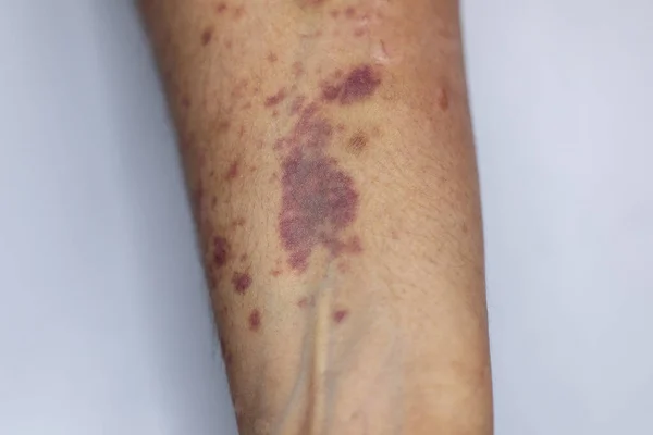 創傷と腕の物理的な外観は 血友病によって引き起こされます Haemophiliaisは 主に遺伝性遺伝性疾患 — ストック写真