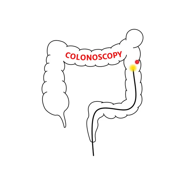 Signo Procedimiento Colonoscopia Lineal Examen Hardware Intestino Grueso Recto Concepto — Archivo Imágenes Vectoriales