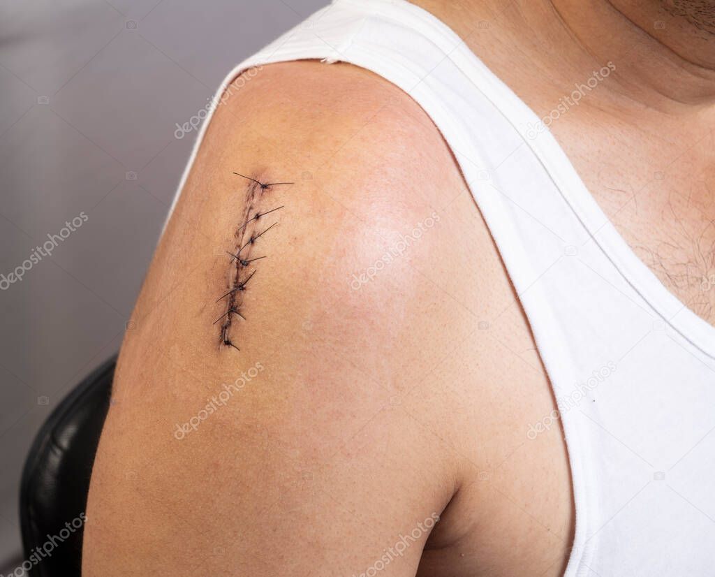 Front side closeup view of surgical incision on upper right shoulder joint closed with sutures