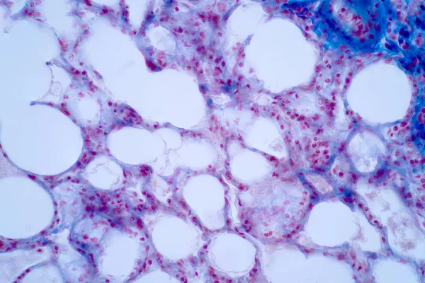 Menselijke Longpathologie Onder Lichte Microscoop Longen Zijn Organen Van Het — Stockfoto